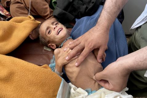 Tragis, 3,7 Juta Anak Afghanistan Alami Kekurangan Gizi Akut